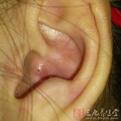 耳廓之中有它你可要小心(3)
