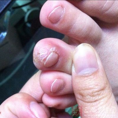 这里破皮竟会导致截肢(3)