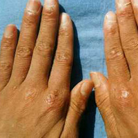湿疹是怎么引起的_湿疹的症状及治疗方法