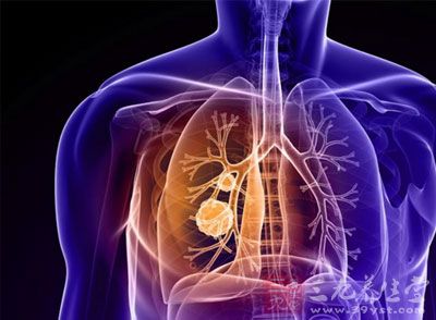 肺癌患者存活率与239个基因表达有关