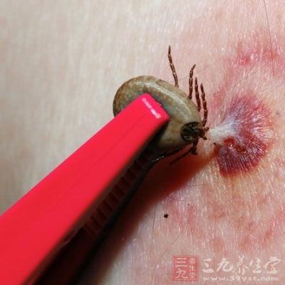 野外露营当心惹上 莱姆 病 - 三九养生堂