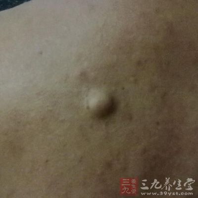 案例:西蒙森31岁,头些年左大腿上面的(好像在表层脂肪中)长了十几个瘤