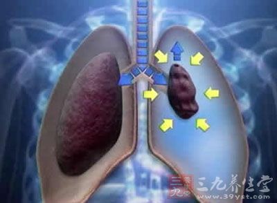 肺萎陷大于50%,称为大量气胸,病人出现胸闷,胸痛和气促症状