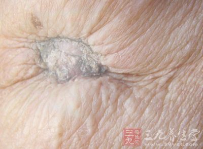 乳头溃烂一年多没当回事 27岁女子患上乳腺癌