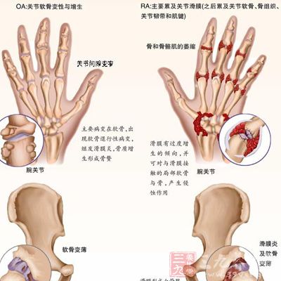 患者患有类风湿关节炎、糖尿病、甲状腺功能低下，则必须首先积极治疗原发病