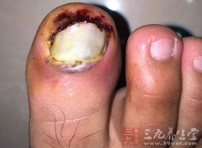 走路滑一跤脚趾流脓 87岁 老糖友 需要截肢保命