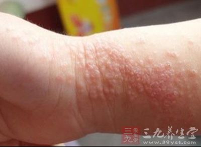 急性湿疹是常见的皮肤病,初起时多为红斑
