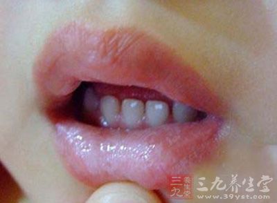 口疮是指口腔粘膜上生黄白色如豆样大或绿豆大的溃点