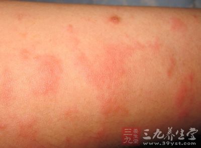 局部先有水皰及渗液等症状加重 局部先有水皰及渗液等症状加重