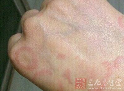 是以阵发性皮肤瘙痒和皮肤苔藓化为特征的慢性皮肤病.