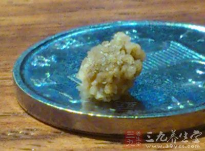 咳嗽两年多未治愈 原来是支气管里长结石