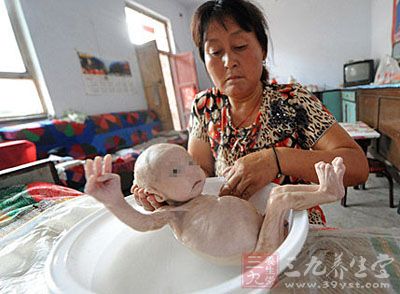 山西无肛男婴肠造瘘手术顺利 术后增重一斤多