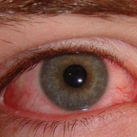 麻桂二陈汤治疗卡他性结膜炎--三九养生堂专家