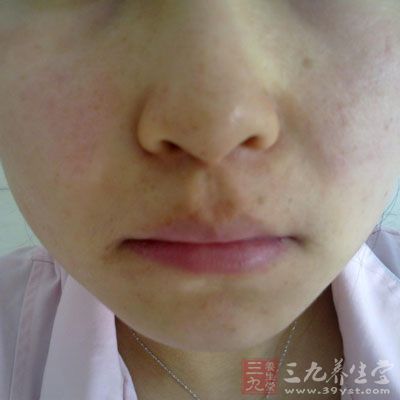 皮肤过敏症状 皮肤过敏会产生的七大症状(2)