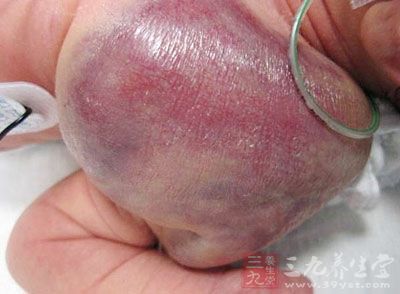 老年性血管瘤