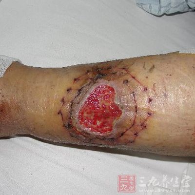 静脉曲张的症状 静脉曲张严重吗有哪些危害(2