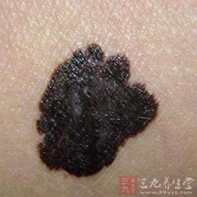 指甲下出现黑斑   主要是由于甲下皮肤组织渗血出现黑色弥漫性淤血斑