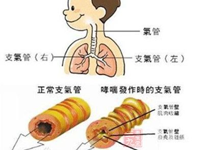 支气管炎