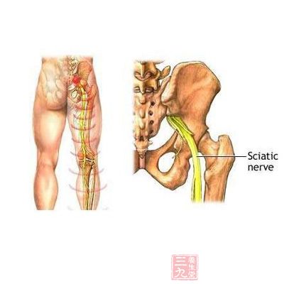 坐骨神经痛的原因 坐骨神经痛其实是慢性腰腿痛