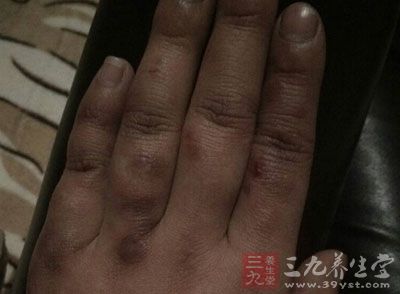 如何预防冻疮 4个方法有效预防冻疮