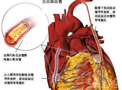 稳定性冠心病和急性冠状动脉综合征