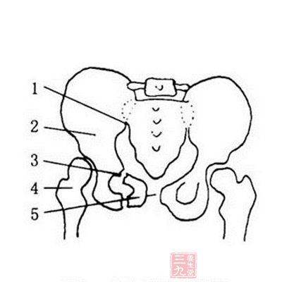 骨盆骨折的分型 骨盆骨折会有哪些并发症