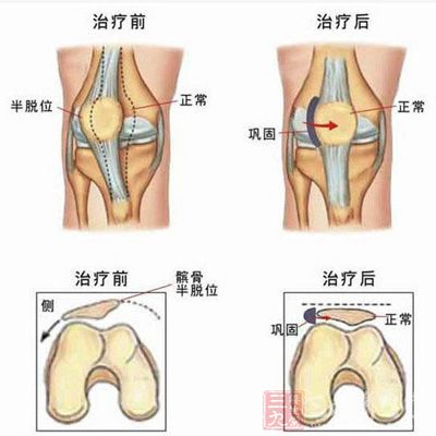 髌骨骨折怎么办 髌骨骨折各期治疗方法(2)