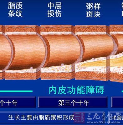 促进动脉粥样硬化的形成