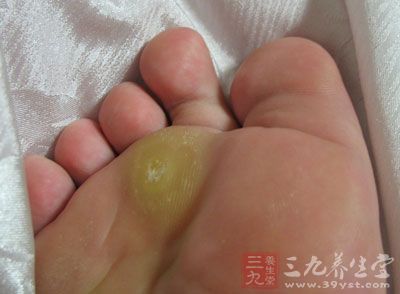 专家指出,病毒疣是因感染人类乳突病毒(HPV)所