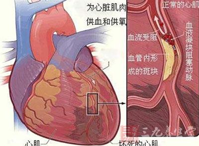 右室心肌梗死的症状 心肌梗死有哪些表现