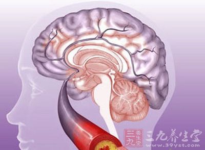 脑血栓形成是脑梗死常见的类型