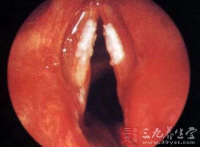 其实我们都知道声带息肉会导致喉癌的发生,但声音嘶哑也会诱发癌症的