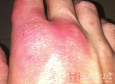 冻疮的病因 找准病因根除冻疮