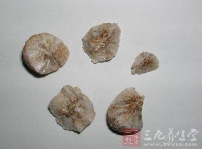 胆石性肠梗阻-三九养生堂养生百科