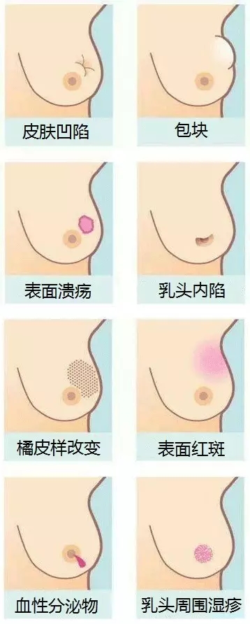 看看乳腺癌征象图，乳房不适请自我对照