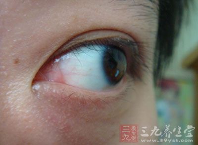 见于重症眼病后期,如虹膜睫状体炎,绝对期青光眼