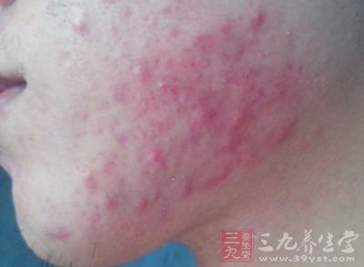 粉刺-三九养生堂养生百科