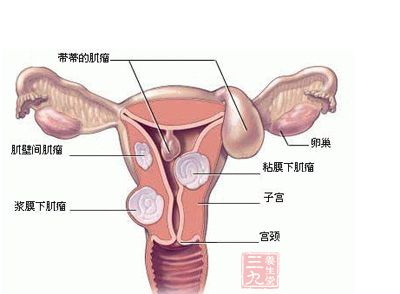 子宫肌瘤治疗 子宫肌瘤吃中药有用吗
