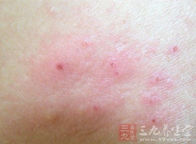 临床表现最多的常为类丹毒型,是一种急性的但进展缓慢的皮肤疾病.