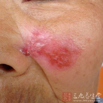 盘状红斑狼疮主要侵犯皮肤，是红斑狼疮中最轻的类型