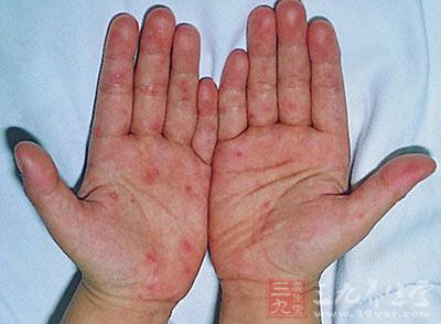 手足口病的初期症状_手足口病的预防措施及传