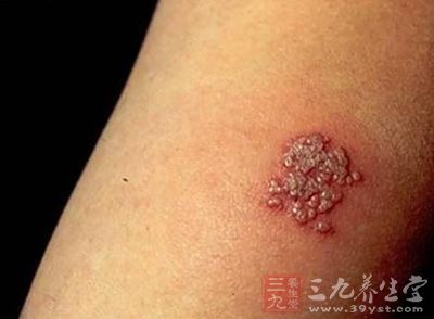 疱疹,中医称为热疮,是一种由疱疹病毒所致的病毒性皮肤病