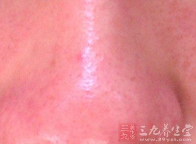 因为脸红远不只是尴尬困窘的心理在皮肤上的外在表征 因为脸红远不只是尴尬困窘的心理在皮肤上的外在表征