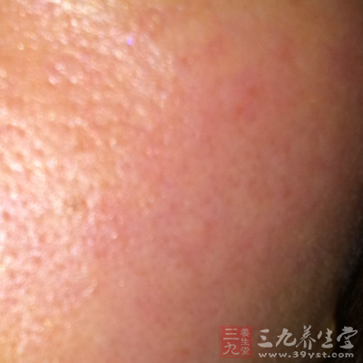 面红是指由于温度或情绪的变化较其他人更容易变红 面红是指由于温度或情绪的变化较其他人更容易变红