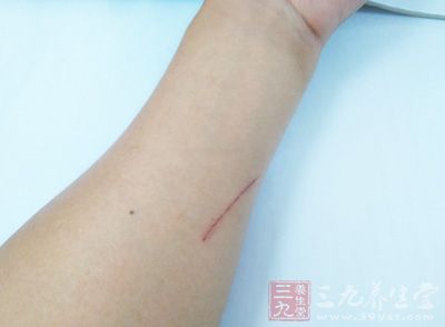 糖尿病人手感染 小伤口差点送命