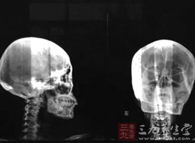 头疼起来跟针扎一样原来脑子里的确有根针