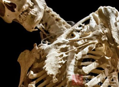珊瑚人肌肉变骨骼背后的机理和治疗方法