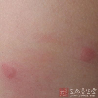 什么是荨麻疹 没蚊子身上也起包竟是这病