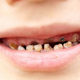 男童从未刷牙20颗牙全烂