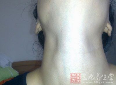 甲状腺囊肿危害